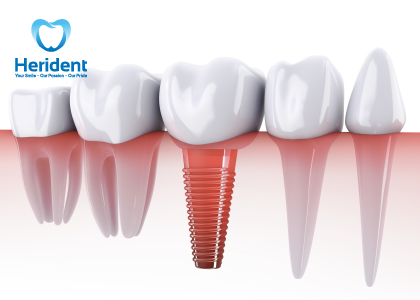 Trồng răng Implant không yêu cầu mài hoặc cắt các răng bên cạnh, bảo vệ cấu trúc của chúng và giữ nguyên tính toàn vẹn của răng tự nhiên xung quanh.