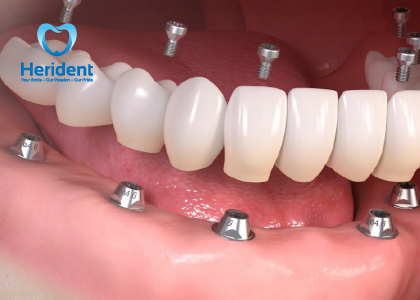 Mão răng sứ trên Implant không chỉ được chế tác với độ chính xác cao mà còn sử dụng công nghệ màu sắc và ánh sáng để tạo ra một nụ cười tự nhiên, thẩm mỹ, phản ánh đến từng chi tiết của răng thật. Điều này đạt tới một tiêu chuẩn cao về vẻ ngoại hình và tự tin cho người sử dụng.