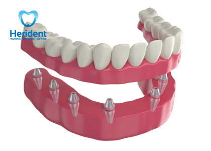 Với độ bền và tuổi thọ cao, răng Implant có khả năng tồn tại trong thời gian dài mà không cần thay thế thường xuyên, mang lại hiệu quả chi phí và sự thoải mái dài hạn cho người sử dụng.